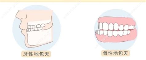 地包天|地包天是骨性还是牙性？一文教你轻松了解分类、判断。